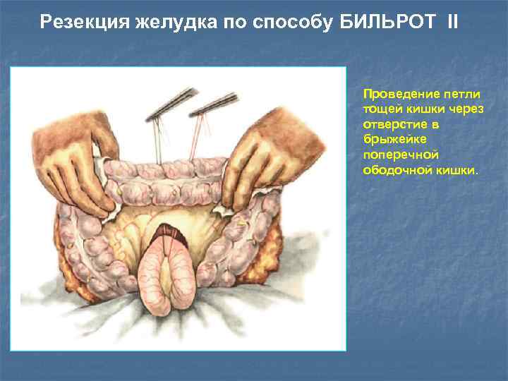 Резекция желудка по способу БИЛЬРОТ II Проведение петли тощей кишки через отверстие в брыжейке