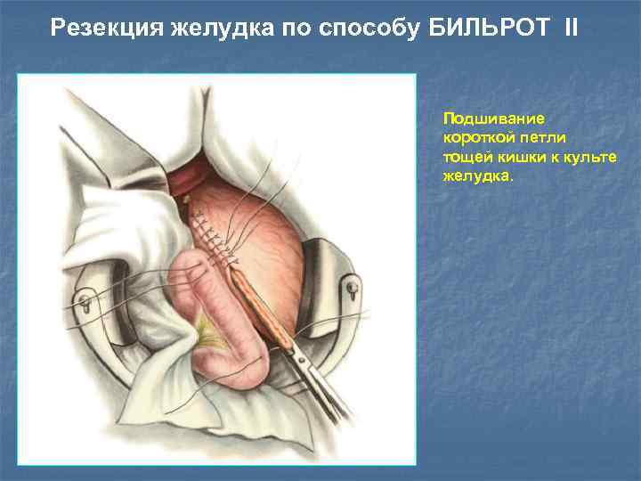 Резекция желудка по способу БИЛЬРОТ II Подшивание короткой петли тощей кишки к культе желудка.