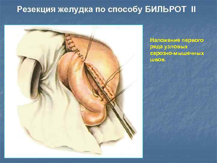 Резекция желудка по способу БИЛЬРОТ II Наложение первого ряда узловых серозно-мышечных швов. 