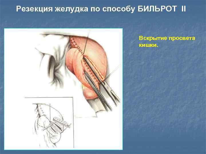 Резекция желудка по способу БИЛЬРОТ II Вскрытие просвета кишки. 