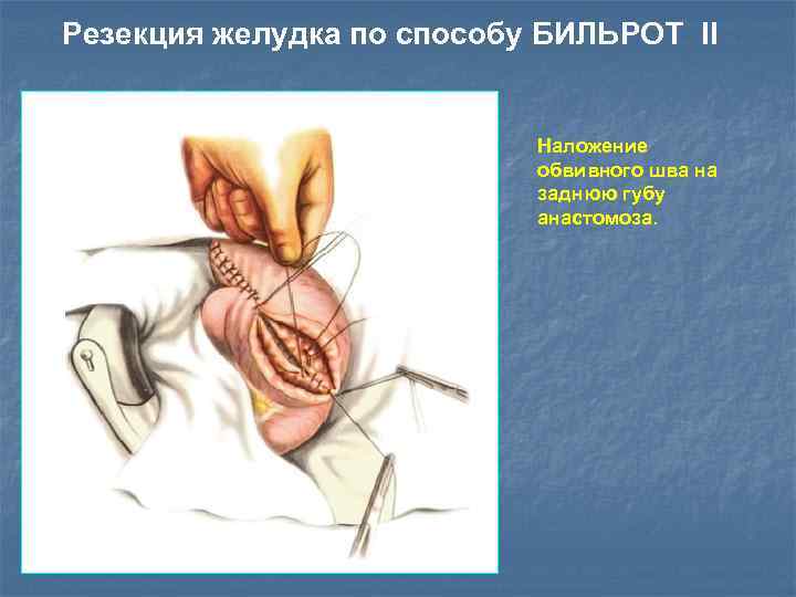 Резекция желудка по способу БИЛЬРОТ II Наложение обвивного шва на заднюю губу анастомоза. 