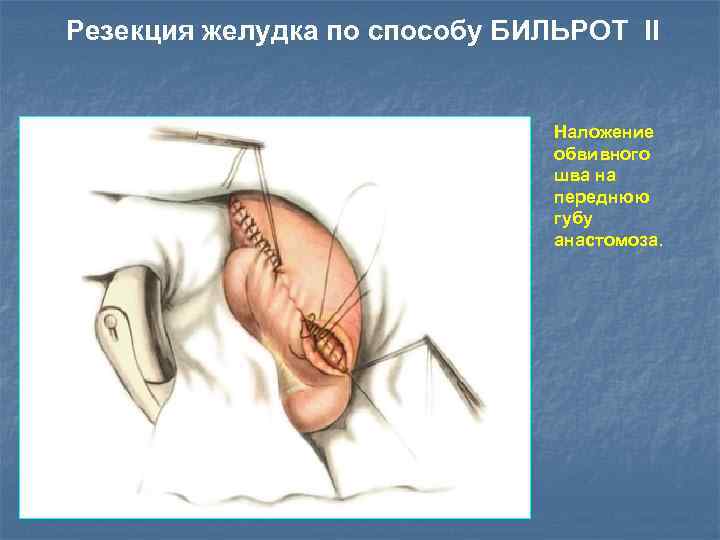 Резекция желудка по способу БИЛЬРОТ II Наложение обвивного шва на переднюю губу анастомоза. 