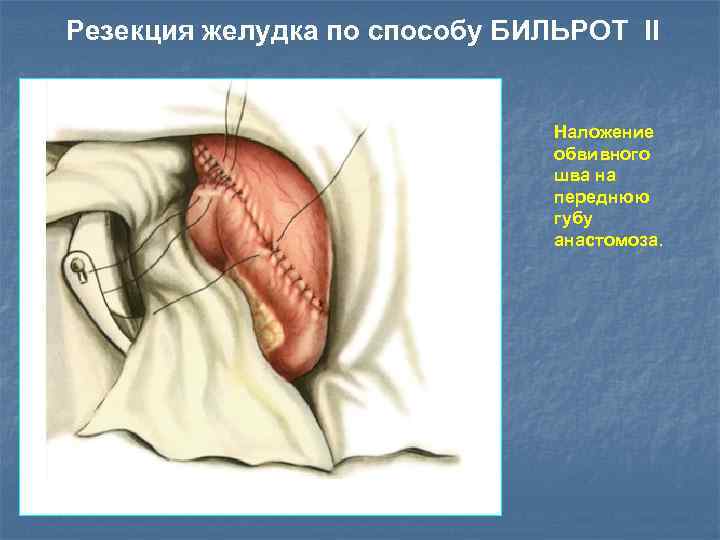 Резекция желудка по способу БИЛЬРОТ II Наложение обвивного шва на переднюю губу анастомоза. 