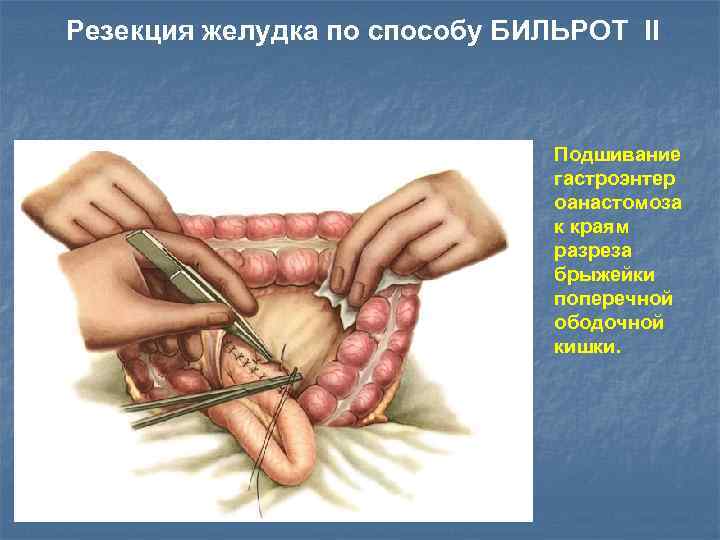 Резекция желудка по способу БИЛЬРОТ II Подшивание гастроэнтер оaнастомоза к краям разреза брыжейки поперечной