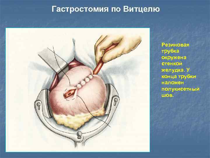 Гастростомия по Витцелю Резиновая трубка окружена стенкой желудка. У конца трубки наложен полукисетный шов.