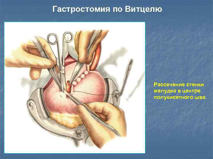 Гастростомия по Витцелю Рассечение стенки желудка в центре полукисетного шва. 