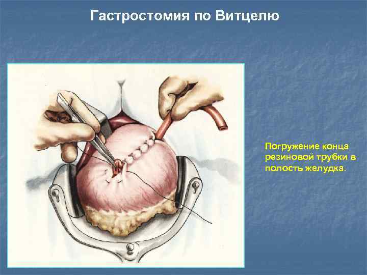 Гастростомия по Витцелю Погружение конца резиновой трубки в полость желудка. 