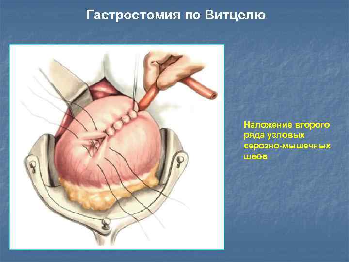 Гастростомия по Витцелю Наложение второго ряда узловых серозно-мышечных швов 