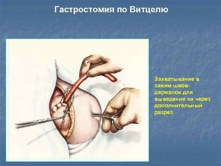 Гастростомия по Витцелю Захватывание в зажим швовдержалок для выведения их через дополнительный разрез. 