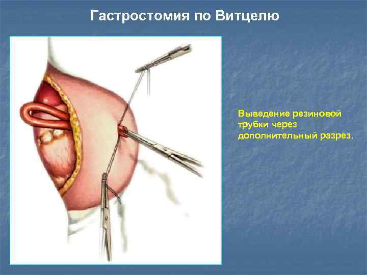 Гастростомия по Витцелю Выведение резиновой трубки через дополнительный разрез. 