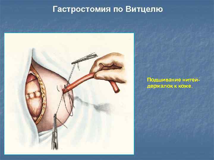 Гастростомия по Витцелю Подшивание нитейдержалок к коже. 