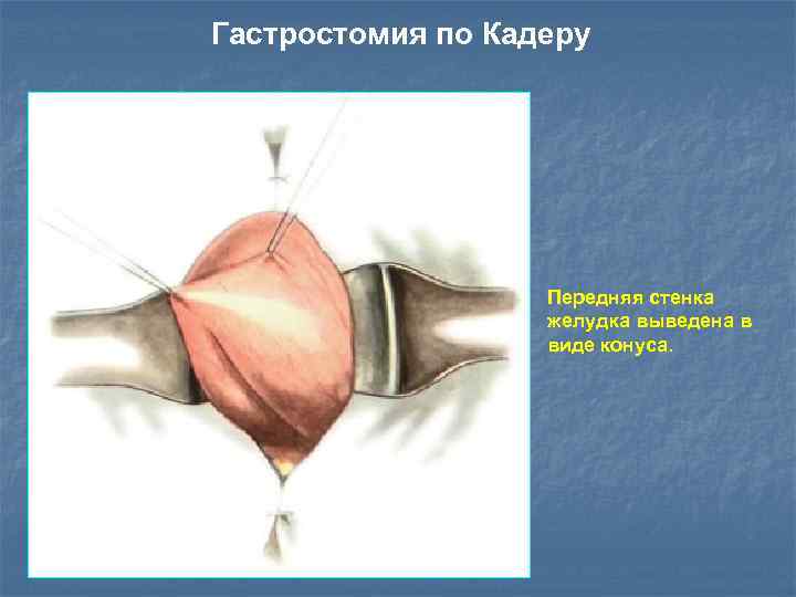 Гастростомия по Кадеру Передняя стенка желудка выведена в виде конуса. 