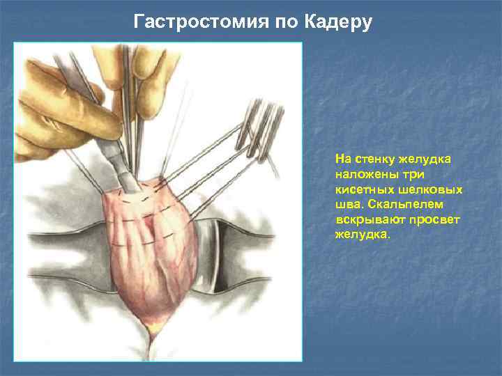 Гастростомия по Кадеру На стенку желудка наложены три кисетных шелковых шва. Скальпелем вскрывают просвет