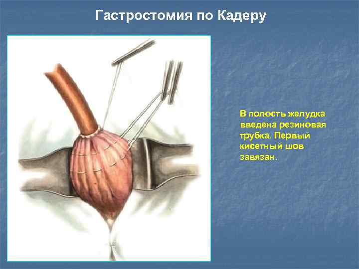 Гастростомия по кадеру