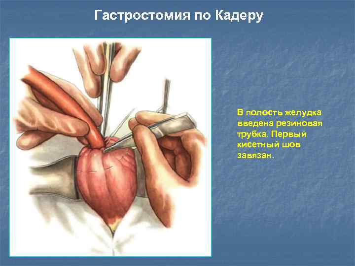 Гастростомия по Кадеру В полость желудка введена резиновая трубка. Первый кисетный шов завязан. 