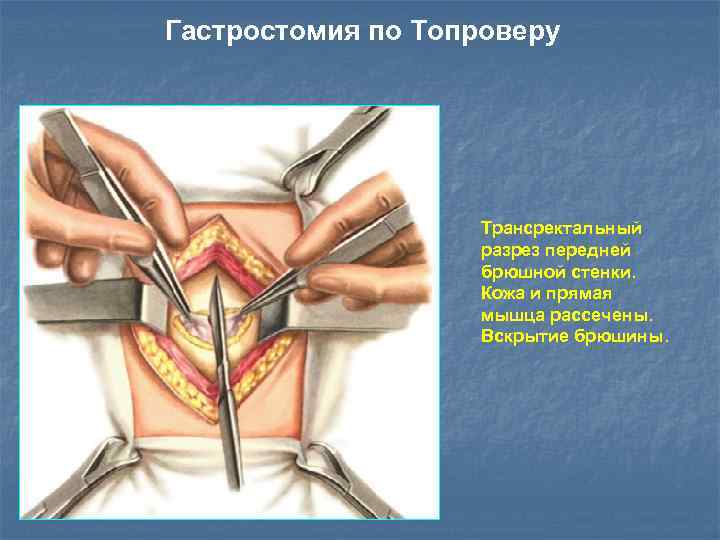 Гастростомия по Топроверу Трансректальный разрез передней брюшной стенки. Кожа и прямая мышца рассечены. Вскрытие