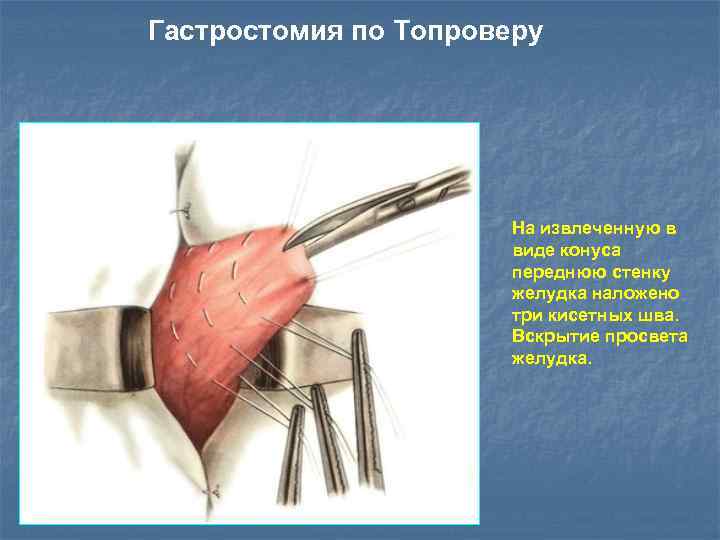 Гастростомия по Топроверу На извлеченную в виде конуса переднюю стенку желудка наложено три кисетных