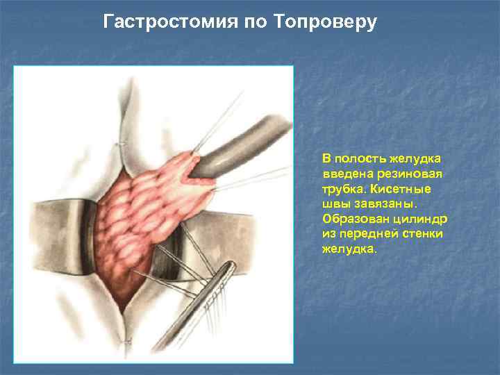 Гастростомия по Топроверу В полость желудка введена резиновая трубка. Кисетные швы завязаны. Образован цилиндр