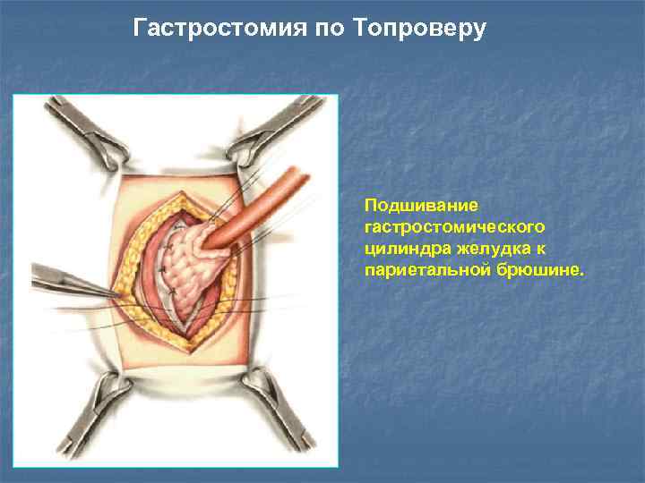 Гастростомия по Топроверу Подшивание гастростомического цилиндра желудка к париетальной брюшине. 