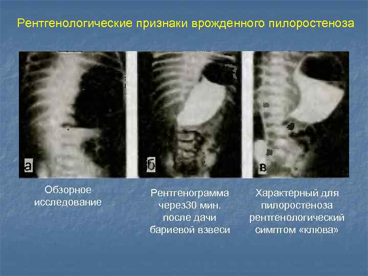 Рентгенологические признаки врожденного пилоростеноза Обзорное исследование Рентгенограмма через 30 мин. после дачи бариевой взвеси