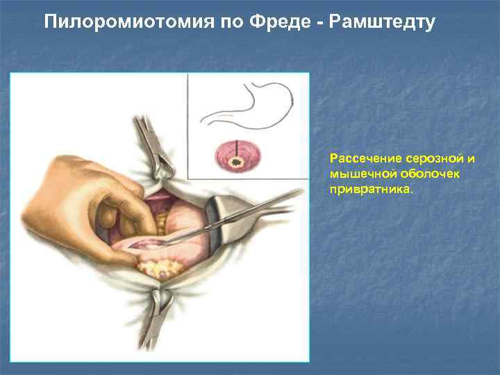 Пилоромиотомия по Фреде - Рамштедту Рассечение серозной и мышечной оболочек привратника. 