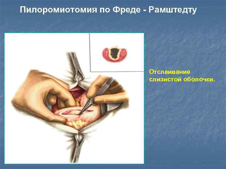 Пилоромиотомия по Фреде - Рамштедту Отслаивание слизистой оболочки. 