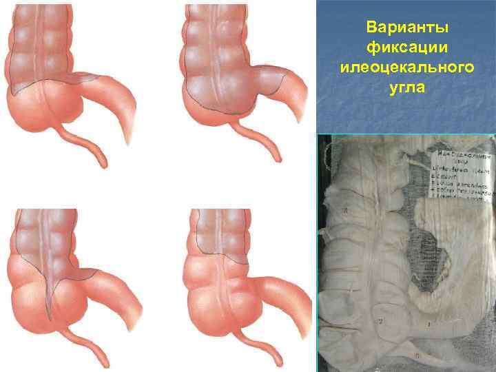 Варианты фиксации илеоцекального угла 