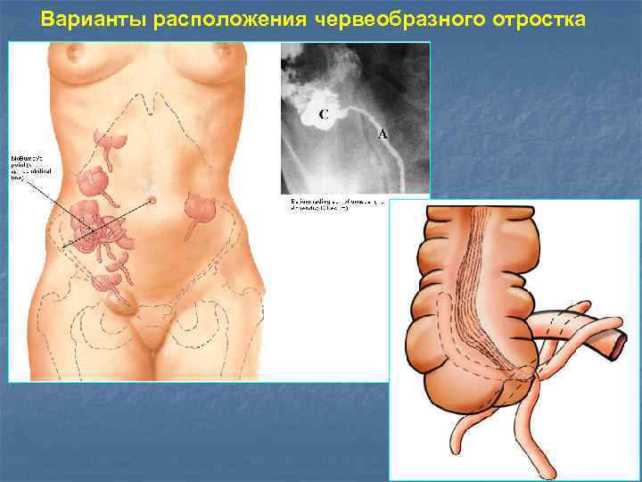 Варианты расположения червеобразного отростка 