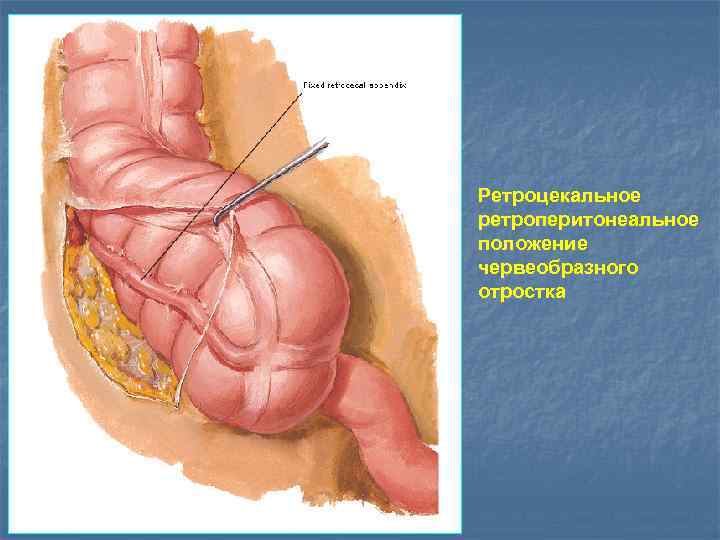 Ретроцекальное ретроперитонеальное положение червеобразного отростка 