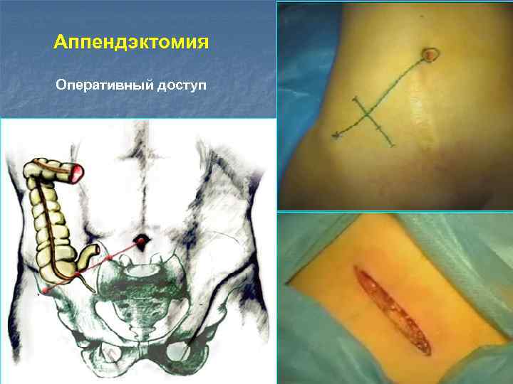 Аппендэктомия Оперативный доступ 