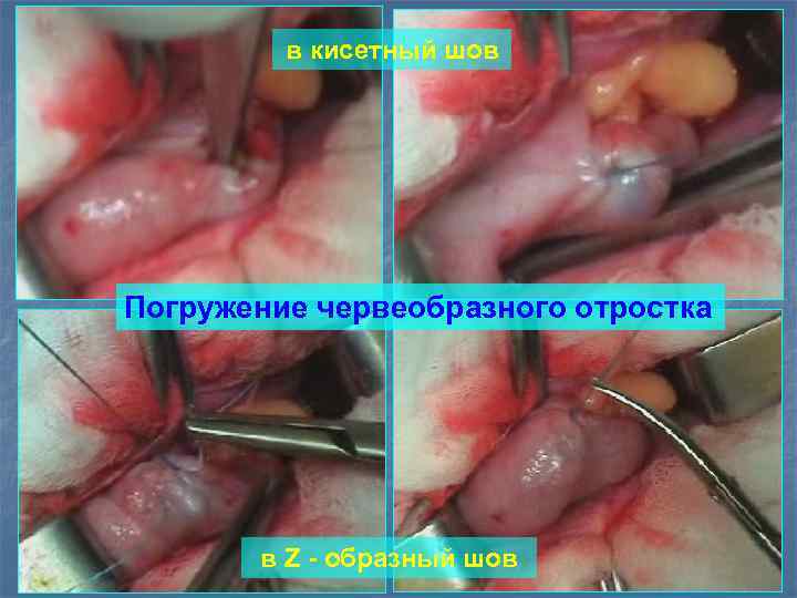 в кисетный шов Погружение червеобразного отростка в Z - образный шов 