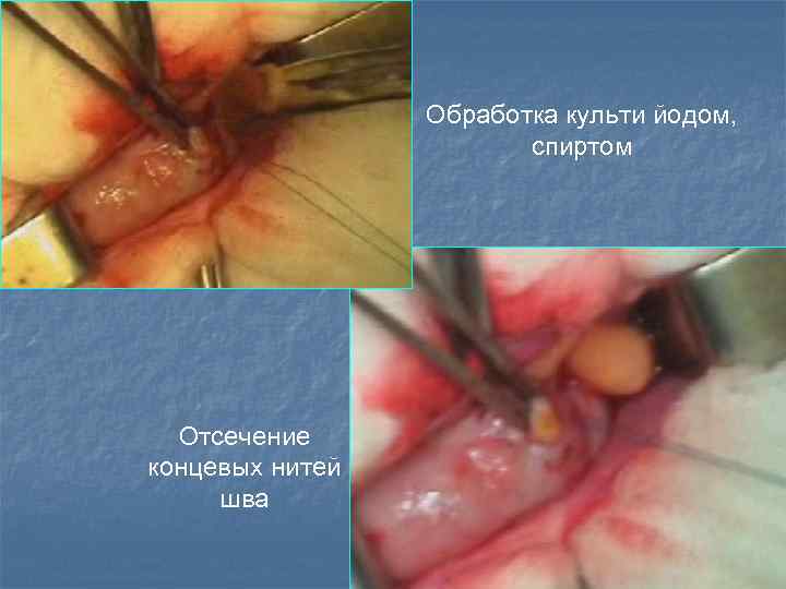 Обработка культи йодом, спиртом Отсечение концевых нитей шва 