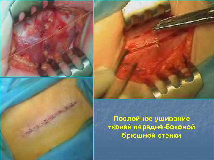 Послойное ушивание тканей передне-боковой брюшной стенки 