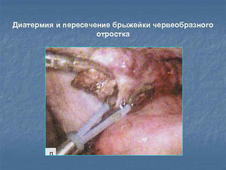 Диатермия и пересечение брыжейки червеобразного отростка 