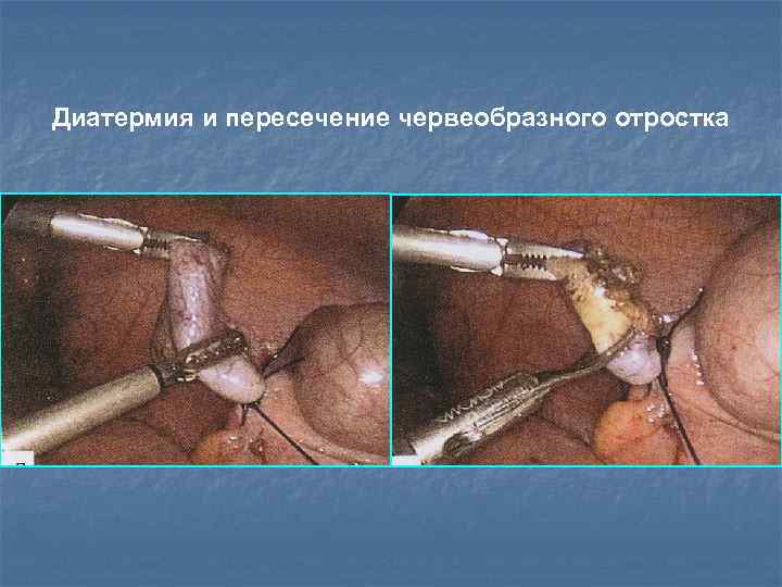 Диатермия и пересечение червеобразного отростка 