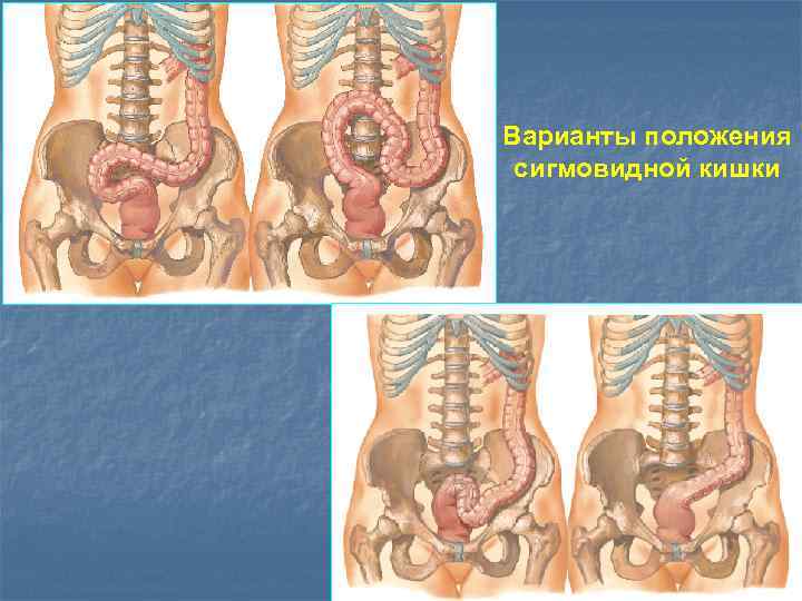 Низкое положение слепой кишки что это такое