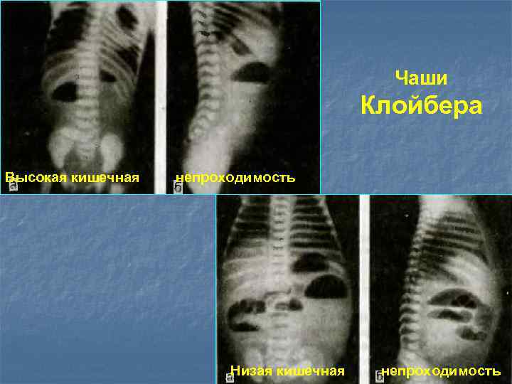 Чаши Клойбера Высокая кишечная непроходимость Низая кишечная непроходимость 