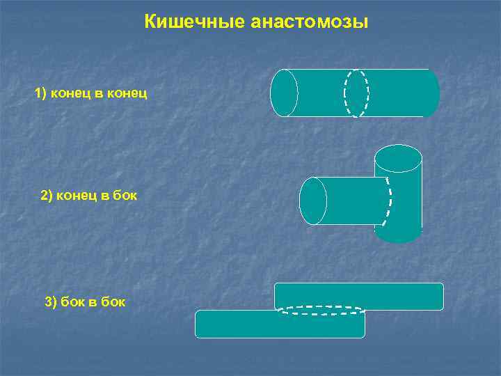 Кишечные анастомозы 1) конец в конец 2) конец в бок 3) бок в бок