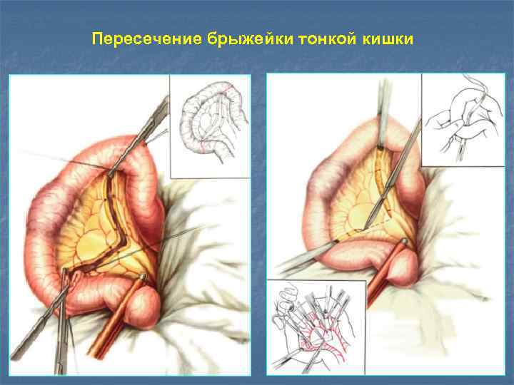 Пересечение брыжейки тонкой кишки 