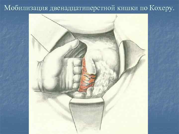 Схема мобилизации двенадцатиперстной кишки по кохеру