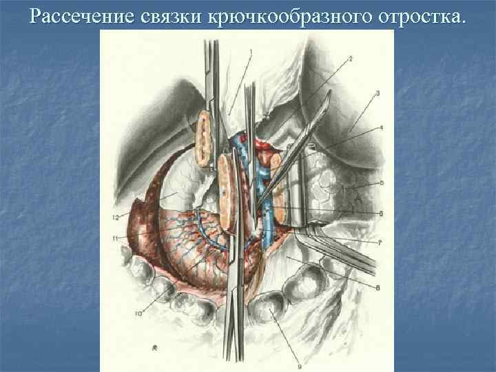 Связки сальника. Хирургическая анатомия селезенки. Связки селезенки анатомия. Утолщение селезеночной-печеночной связки.