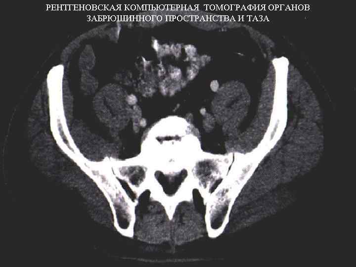 Кт забрюшинного пространства. Кт анатомия забрюшинного. Кт анатомия малого таза. Анатомия забрюшинного пространства на кт. Кт забрюшинного пространства и органов малого таза.