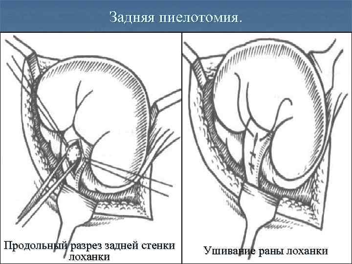 Нефропексия это