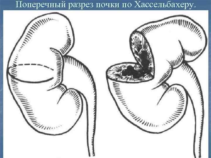 Поперечный разрез почки по Хассельбахеру. 