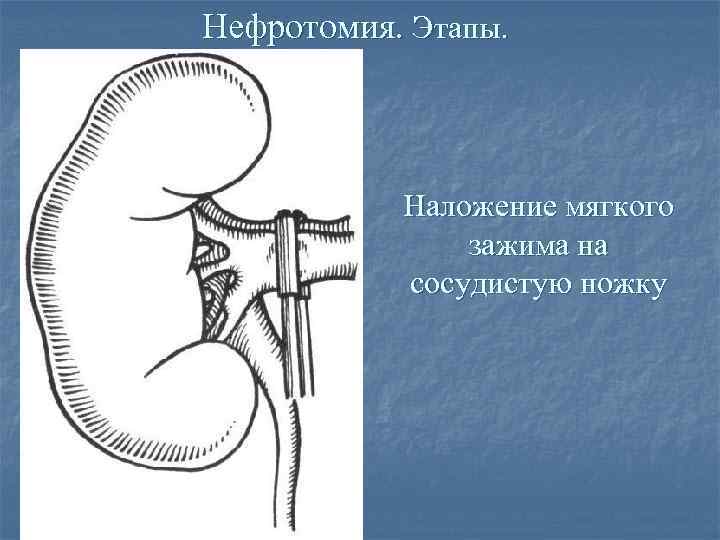 Нефротомия. Этапы. Наложение мягкого зажима на сосудистую ножку 