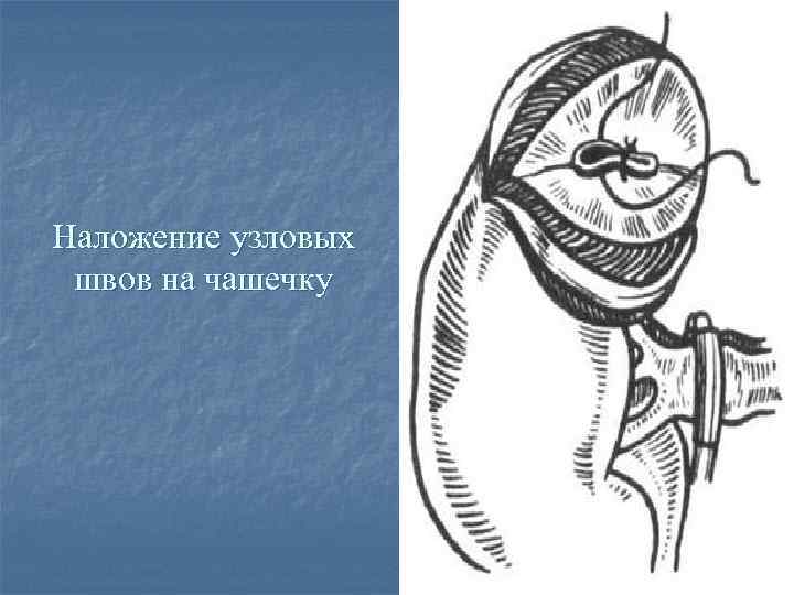 Наложение узловых швов на чашечку 