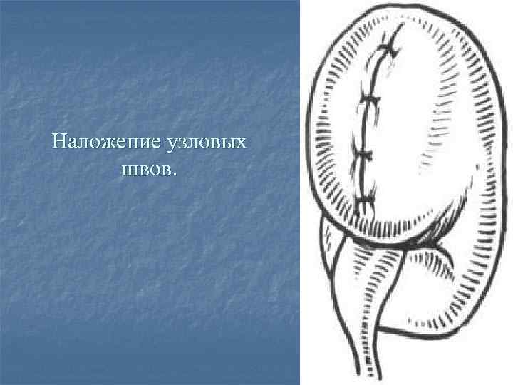 Наложение узловых швов. 