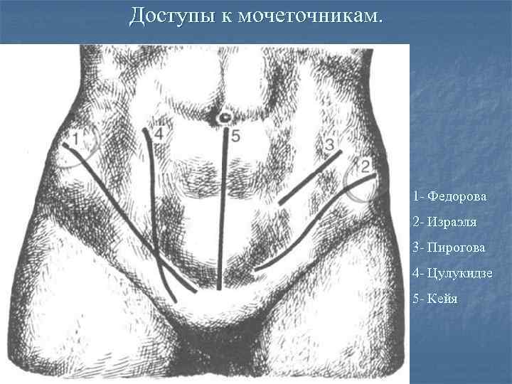 Доступы к мочеточникам. 1 - Федорова 2 - Израэля 3 - Пирогова 4 -