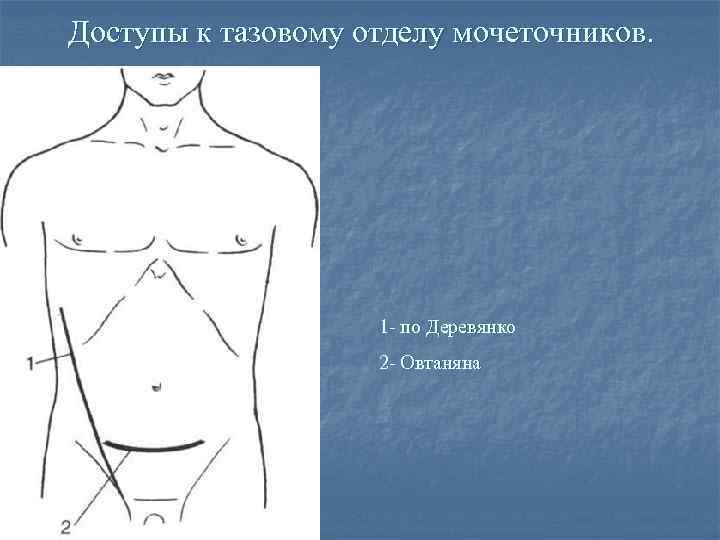 Доступы к тазовому отделу мочеточников. 1 - по Деревянко 2 - Овтаняна 
