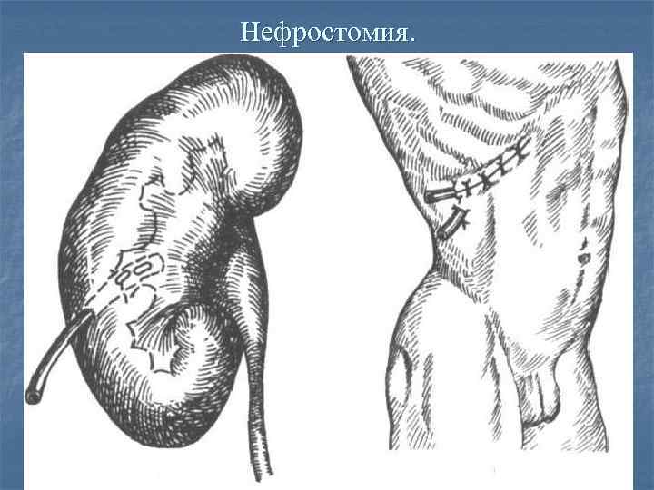 Пункционная нефростомия. Нефростомия топографическая анатомия.